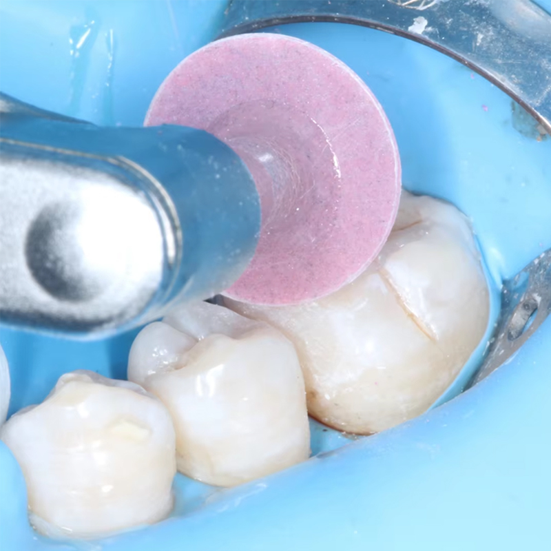 40 szt. Dyski polerskie dentys – Teeth Whitening Express recenzja i cena