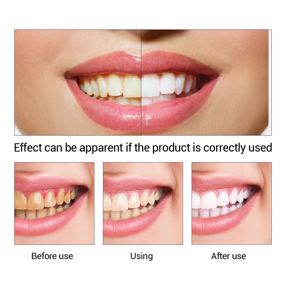 FTEENPLY esencja do wybielania – Teeth Whitening Clinic recenzja i cena