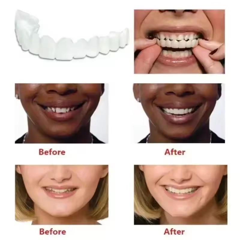 Okładziny na zęby Wybielanie z – Teeth Whitening With Braces recenzja i cena