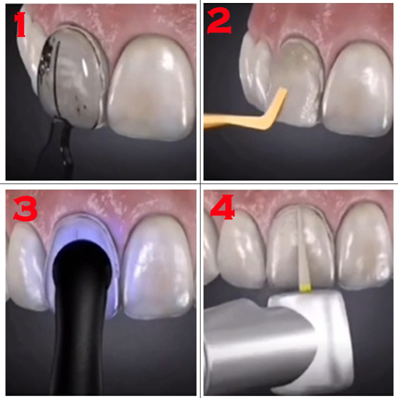 Forma dentystyczna do licówek  – Teeth Whitening Lab recenzja i cena