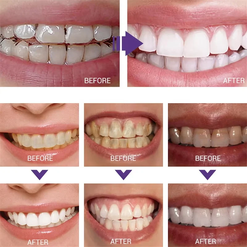 Oczyszczanie zębów Wybielająca – Teeth Whitening Korea recenzja i cena