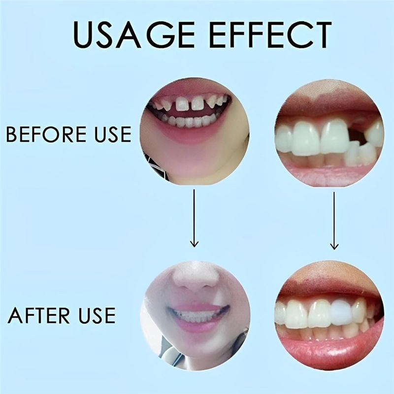 [NOWOŚĆ! ABMK】 2 Pary, Przywró – Teeth Whitening With Braces recenzja i cena